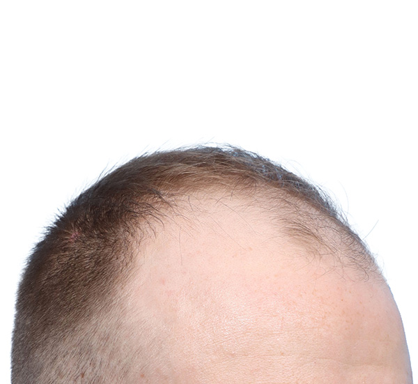 Fue Before and After | Dr. Jeffrey Wise