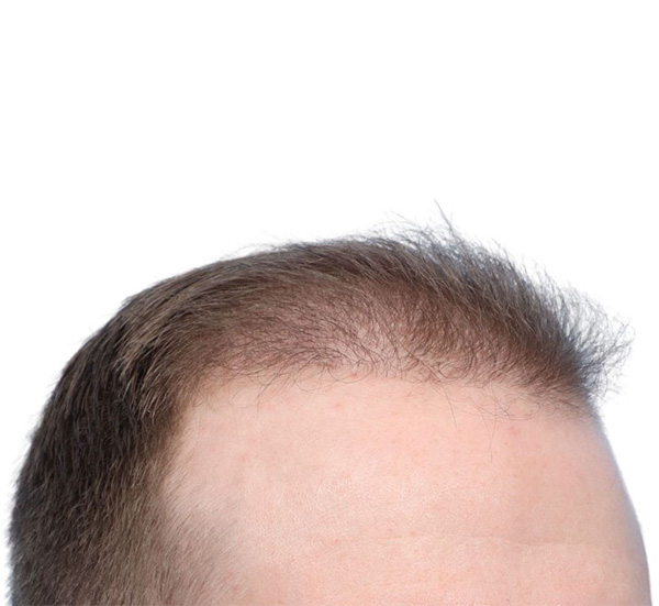 Fue Before and After | Dr. Jeffrey Wise