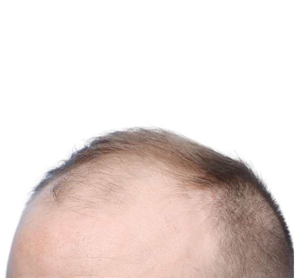 Fue Before and After | Dr. Jeffrey Wise