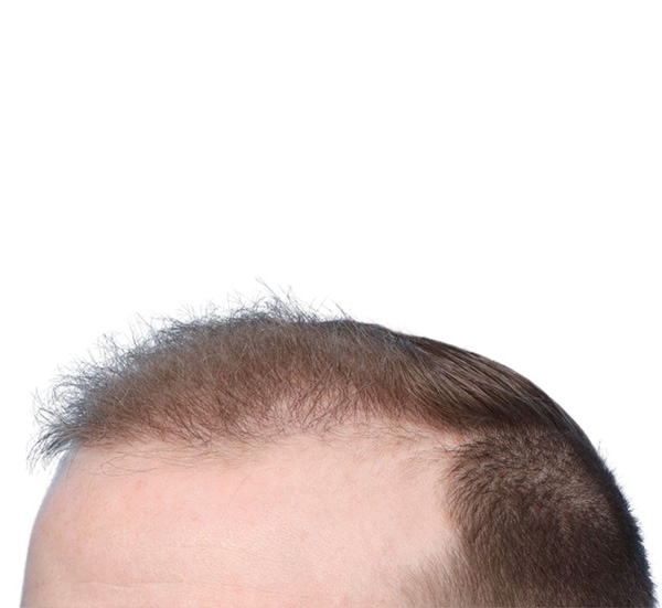 Fue Before and After | Dr. Jeffrey Wise