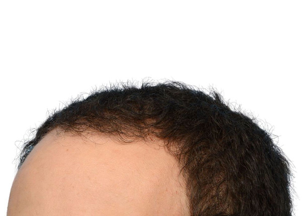 Fue Before and After | Dr. Jeffrey Wise